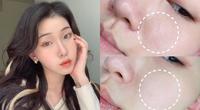 皮秒雷射纪录。第4次。