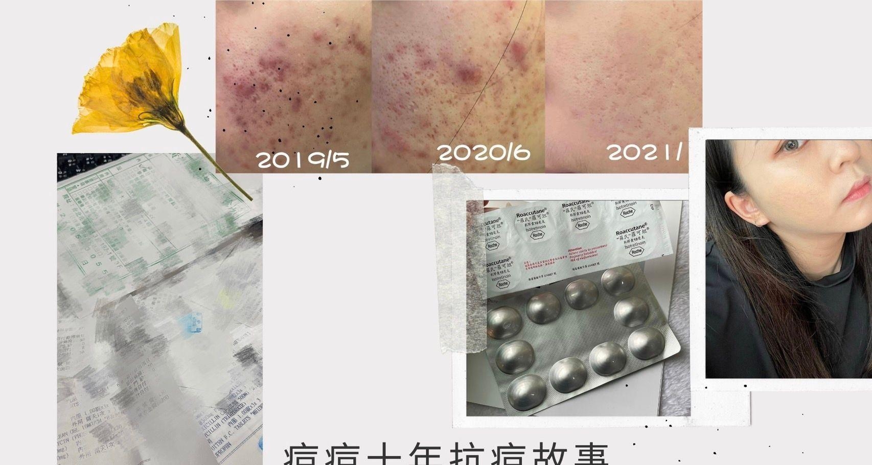 美妆│我的十年抗痘故事内文含心路历程及方法分享一起努力抗痘吧！