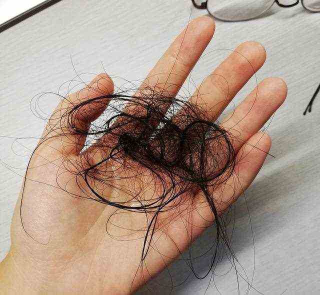 今夜我们不聊人类，我们谈谈脱发 / 疯狂掉发那几年的经验教训