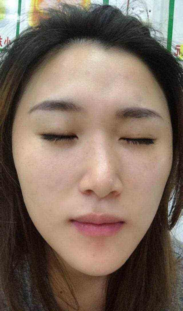 3次祛斑经验，终于和斑点说再见了