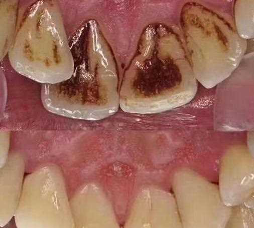 洗牙 你到底了解多少
