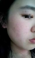 5f4cc150-e787-4372-a2ae-f9e88cf3c70b_1.jpg 读本关注信阳一女士用屈臣氏保湿面膜致脸过敏 因无小票退货难