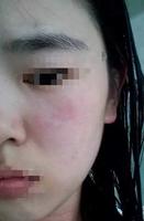 5f4cc150-e787-4372-a2ae-f9e88cf3c70b_2.jpg 读本关注信阳一女士用屈臣氏保湿面膜致脸过敏 因无小票退货难
