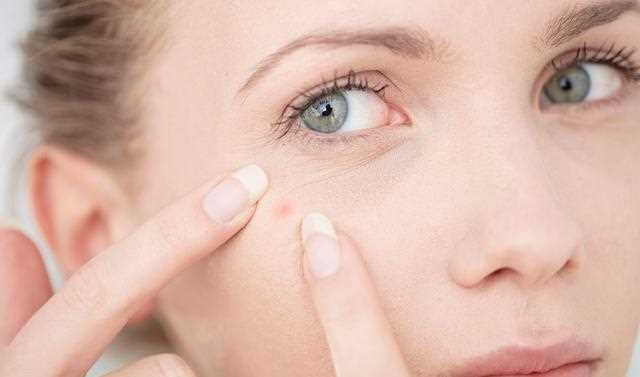 八年战痘，还好我挺过来了（二）