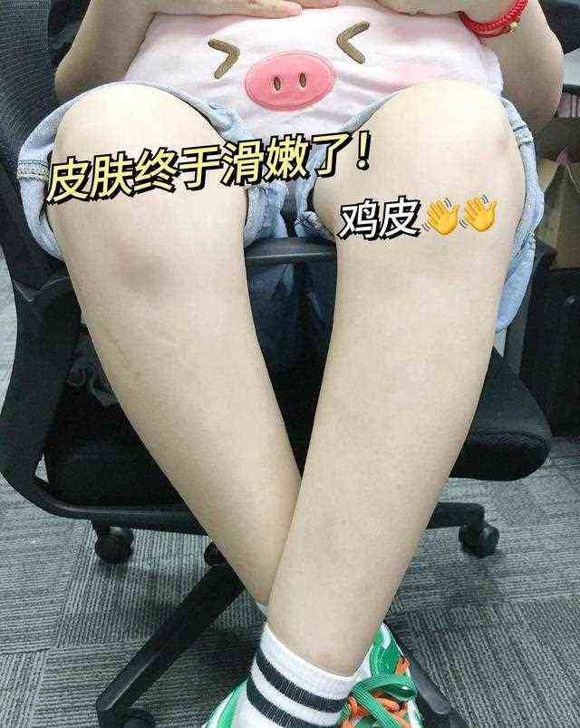 果酸去鸡皮太绝了，怪不得每天都能看到姐妹安利