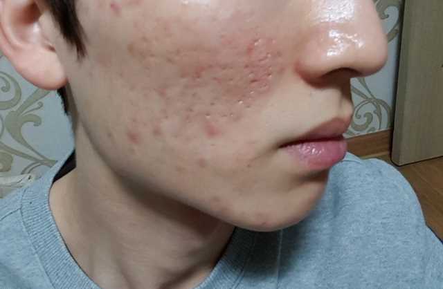 从“毁容”到皮肤光滑平整，3年的“痘坑”终于好了
