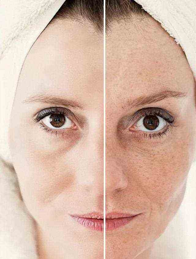 光子嫩肤——求美者的宠儿