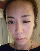 陈仙梅遭儿手指插眼　眼球破大洞肿如核桃