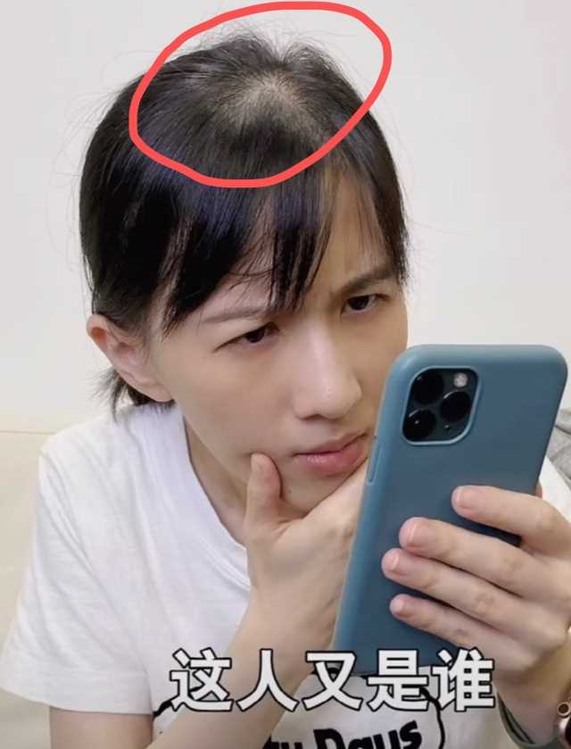 papi酱生孩后变化大，面容憔悴发量少到快秃顶，连人气都没了