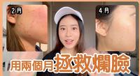 拯救烂脸没自信的半年...用两个月拯救回来？ #台北做脸