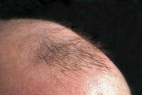 小伙贷款2.5万种头发，美容院承诺存活率95%，一个月后全秃了