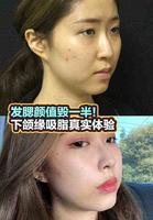 发腮颜值毁一半!下颌缘吸脂体验 发腮颜值毁一半!下颌缘吸脂体验