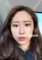 发腮颜值毁一半!下颌缘吸脂体验 发腮颜值毁一半!下颌缘吸脂体验