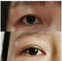 前段时间去北京，做了提眉手术，我来“透露”一些真相