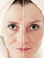 光子嫩肤——求美者的宠儿