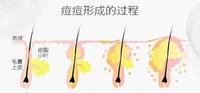 一痘毁所有,想要祛痘不留印,涂涂这个好得快 一痘毁所有,想要祛痘不留印,涂涂这个好得快