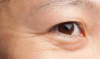 d2ce3391-a34e-4c00-af6a-d2e219a7e8c4_1.jpg-s 银泰云店 | 眼角皱纹怎么去除?不同的眼纹,改善的方法可不一样